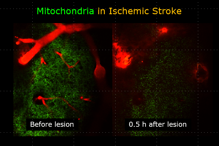Changes in mitochondrial morphology and function after ischemic stroke